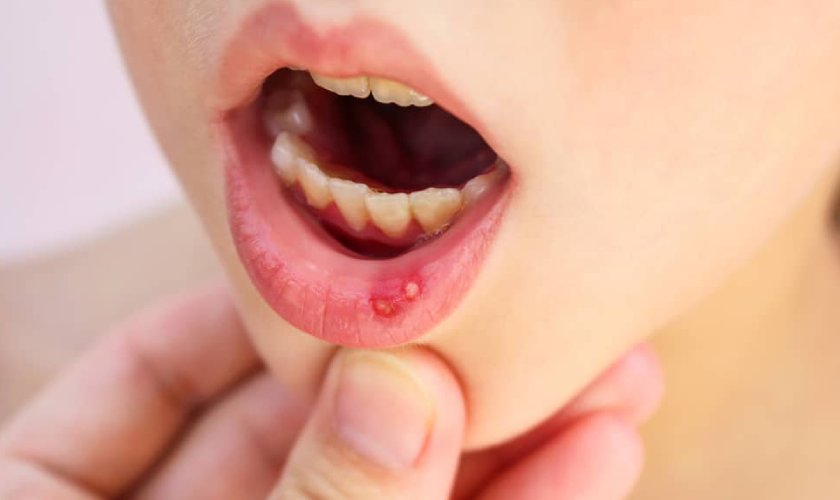 Ứng phó với 'nóng trong', nổi mụn, nhiệt miệng mùa xuân - Ảnh 1.