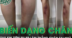 Cô gái 29 tuổi biến dạng hai cẳng chân sau khi tiêm filler làm thẳng chân tại nhà