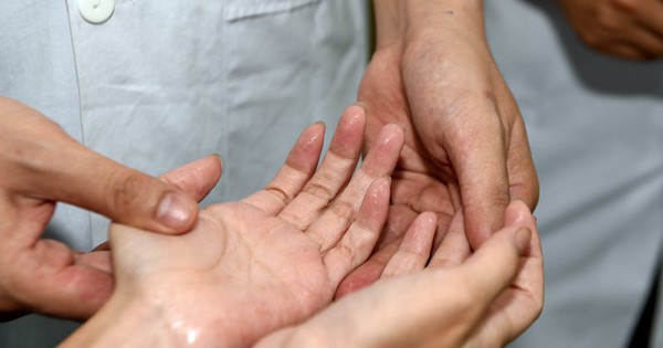 Giải pháp hỗ trợ điều trị giảm đổ mồ hôi tay hiệu quả