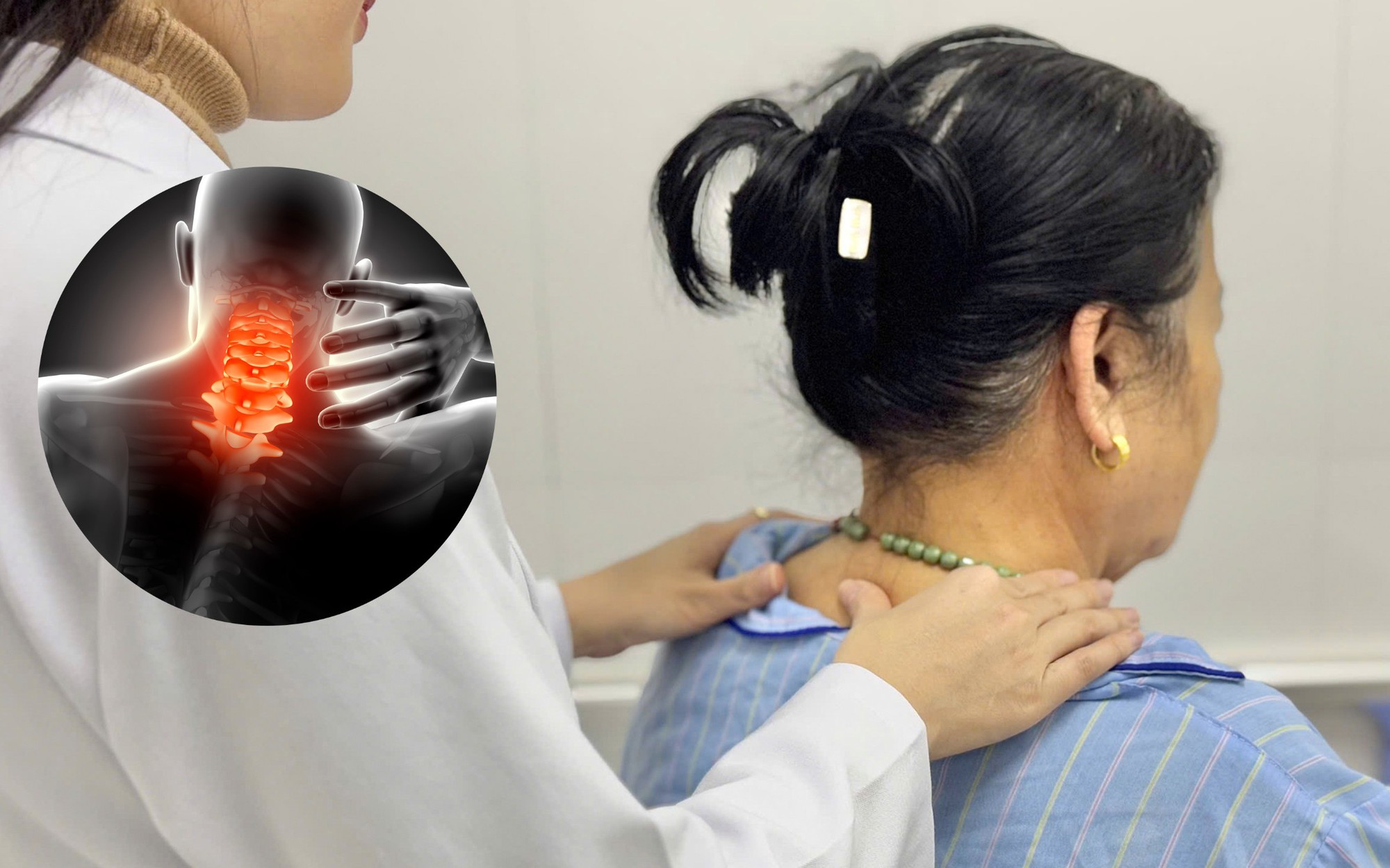 Nguy cơ liệt nếu không điều trị thoát vị đĩa đệm