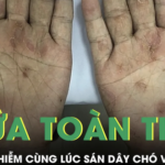 Ngứa toàn thân suốt 2 tháng, người đàn ông phát hiện nhiễm cùng lúc sán dây chó và giun đũa