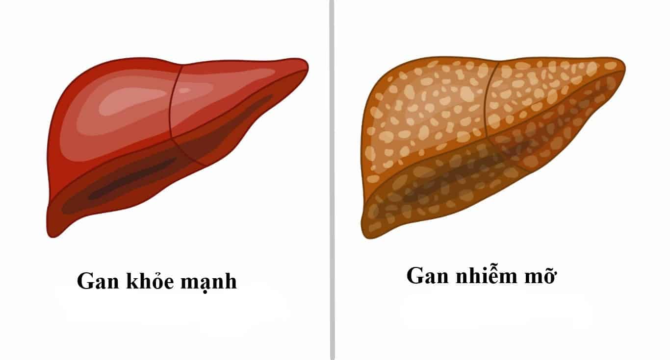 Chế độ ăn cho người gan nhiễm mỡ- Ảnh 2.