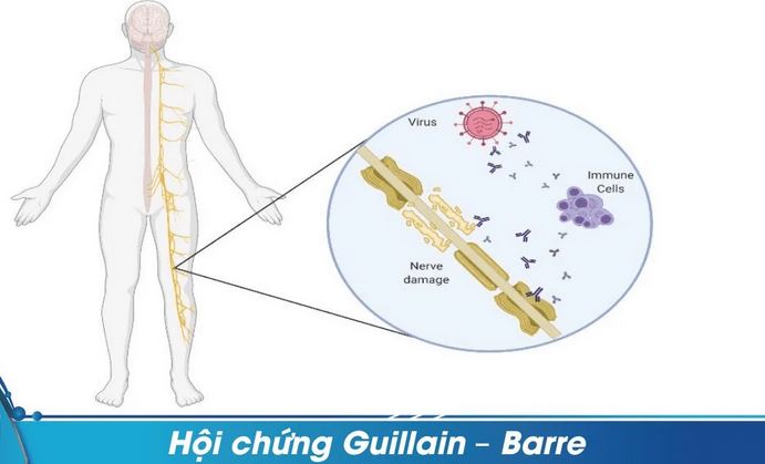 Hội chứng Guillain-Barré dễ bị nhầm với nhiều bệnh lý thần kinh- Ảnh 1.