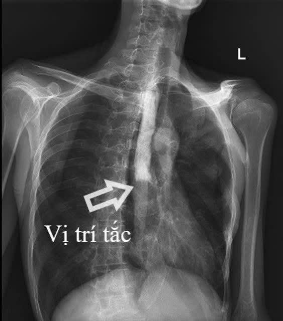 Cứu sống người đàn ông bị thủng đường tiêu hóa nhiều lần ở Quảng Ninh- Ảnh 2.