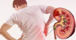 Sỏi thận có thể tự đào thải trong bao lâu, khi nào cần can thiệp?