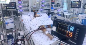 Bé 11 tuổi bị co giật do biến chứng viêm cầu thận sau viêm họng liên cầu