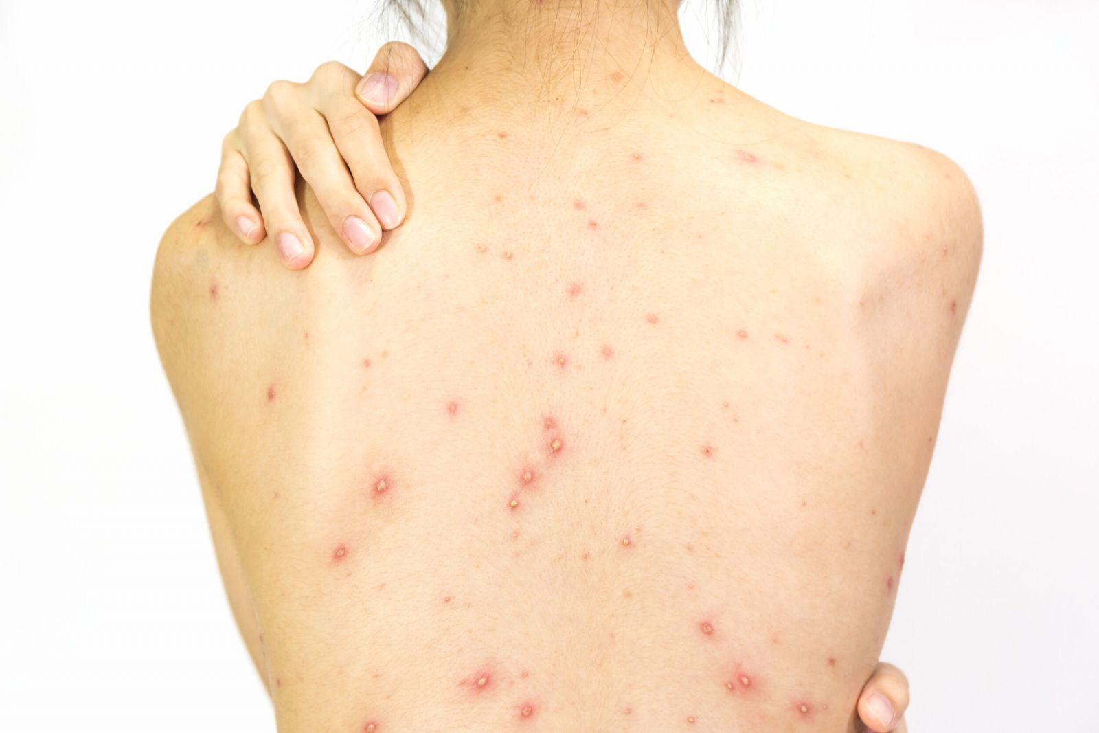 Nguyên nhân mọc mụn trứng cá ở lưng, yếu tố thường gặp nhưng dễ bị bỏ qua- Ảnh 1. Nguyên nhân mọc mụn trứng cá ở lưng, yếu tố thường gặp nhưng dễ bị bỏ qua- Ảnh 1.