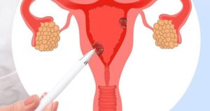 Hội chứng buồng trứng chuyển hóa đa nội tiết – tên gọi mới của hội chứng buồng trứng đa nang