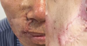 Vì sao ‘mổ đi mổ lại’ vẫn không hết ung thư da?