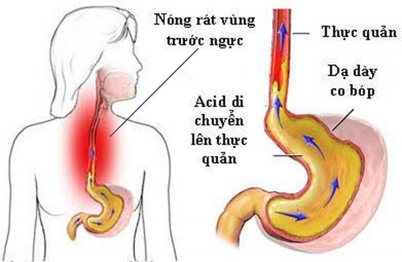 5 nguy cơ khi dùng nhiều thuốc giảm tiết acid ở người trào ngược dạ dày - thực quản- Ảnh 1.