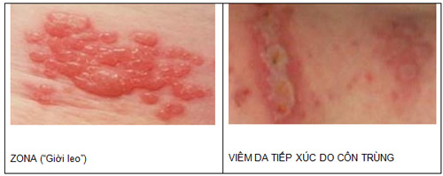 Nhận biết vết côn trùng cắn, đốt và cách xử trí đúng để tránh biến chứng nguy hiểm