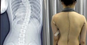 Vẹo cột sống ở trẻ gây hệ lụy gì?