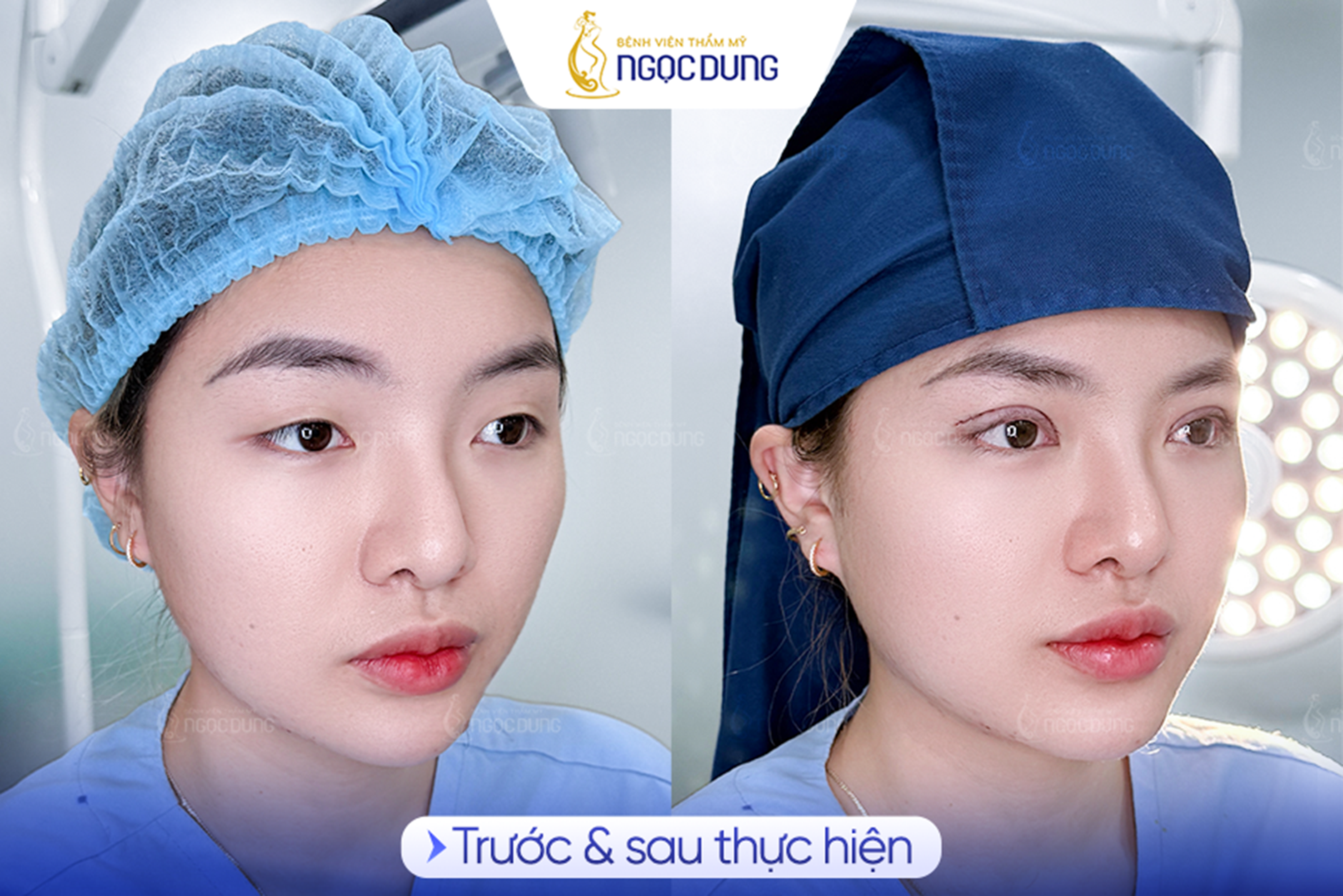 Có nên cắt mí mắt? Phân tích từ chuyên gia- Ảnh 3. Có nên cắt mí mắt? Phân tích từ chuyên gia- Ảnh 3.