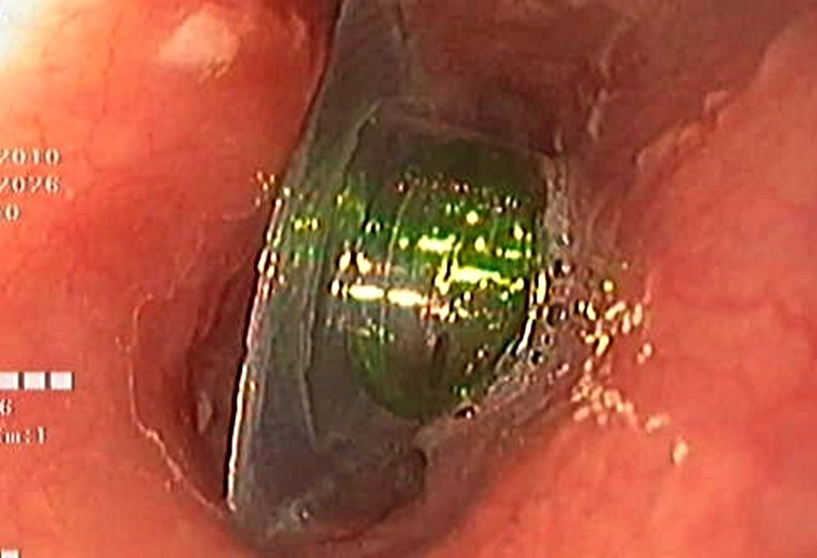 Bé trai nuốt nguyên viên thuốc còn vỏ, bác sĩ cảnh báo biến chứng nguy hiểm- Ảnh 1.