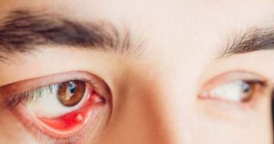 Nguyên nhân gây cộm mắt và cách khắc phục
