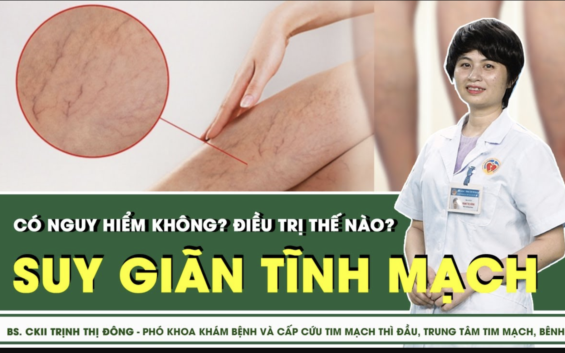 8 cách giúp cải thiện bệnh suy giãn tĩnh mạch tại nhà