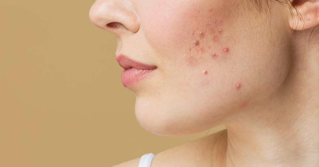Da bùng mụn ngày hè: Nên chọn sản phẩm ngừa mụn nào?