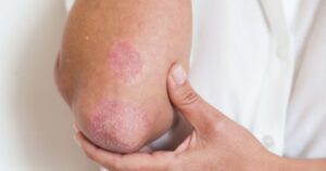 Người mắc bệnh vảy nến đối mặt áp lực tâm lý kéo dài nhiều năm