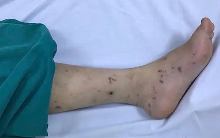 Bé 2 tuổi tử vong do não mô cầu thể tối cấp tại TPHCM