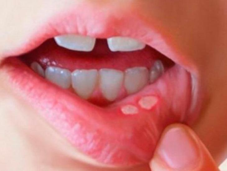 nhiet-mieng-1-17265711159682001735405 Phân biệt nhiệt miệng và ung thư lưỡi: Cách nhận biết sớm căn bệnh nguy hiểm- Ảnh 1.