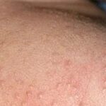 Mùa hè nhiều rôm sảy cần xử trí ra sao?