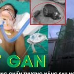 Người đàn ông đứt gan, tràn máu màng phổi sau khi ngã giàn giáo