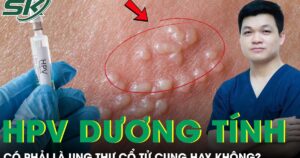 Có phải HPV dương tính là bị ung thư cổ tử cung không?