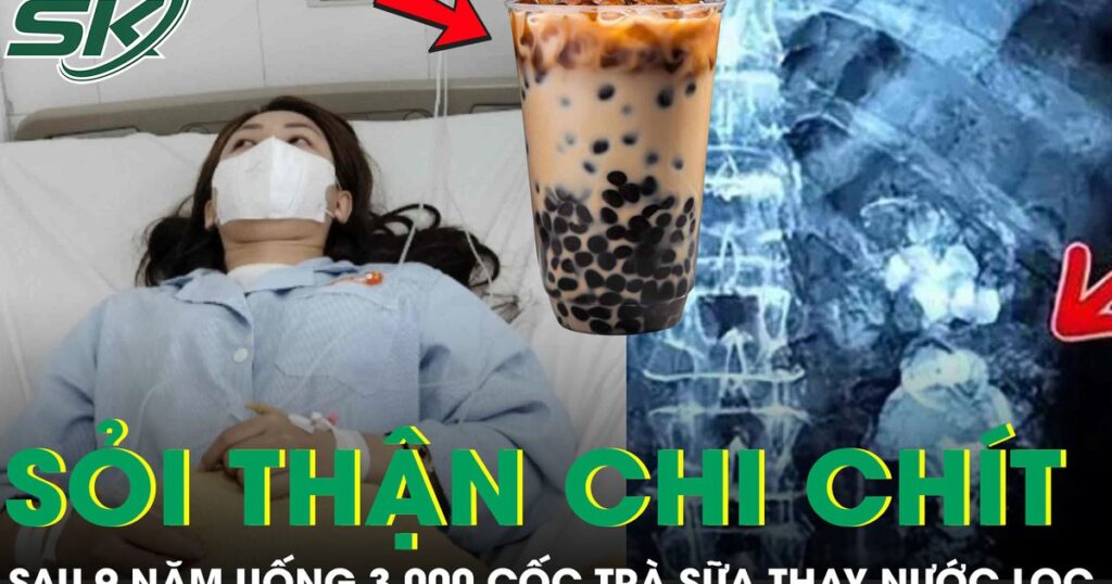 Uống 3.000 cốc trà sữa thay nước lọc suốt 9 năm, thận cô gái mọc chi chít sỏi