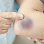 Xuất hiện nhiều vết bầm tím không rõ nguyên nhân cảnh giác với giảm tiểu cầu