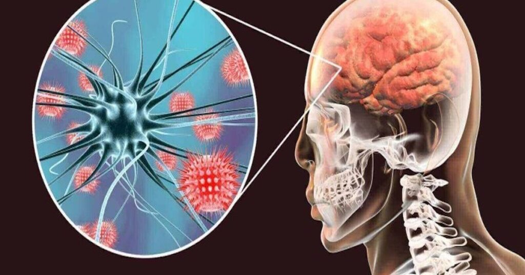 Viêm não tự miễn có nguy cơ tử vong cao nếu chẩn đoán muộn
