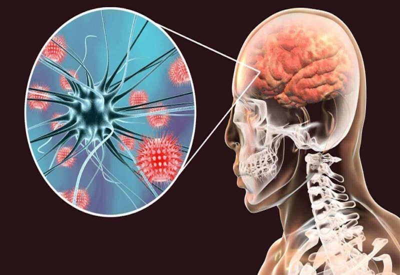 Viêm não tự miễn có nguy cơ tử vong cao nếu chẩn đoán muộn- Ảnh 1.