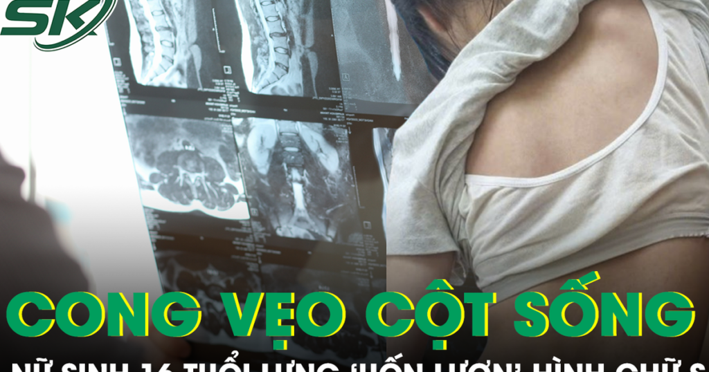 Tự ý ngừng đeo nẹp vì sợ bạn bè trêu chọc, nữ sinh 16 tuổi đối mặt nguy cơ mổ cột sống