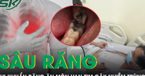 Hơn 10 chiếc răng sâu khiến người đàn ông 57 tuổi bị vi khuẩn ăn mòn van tim
