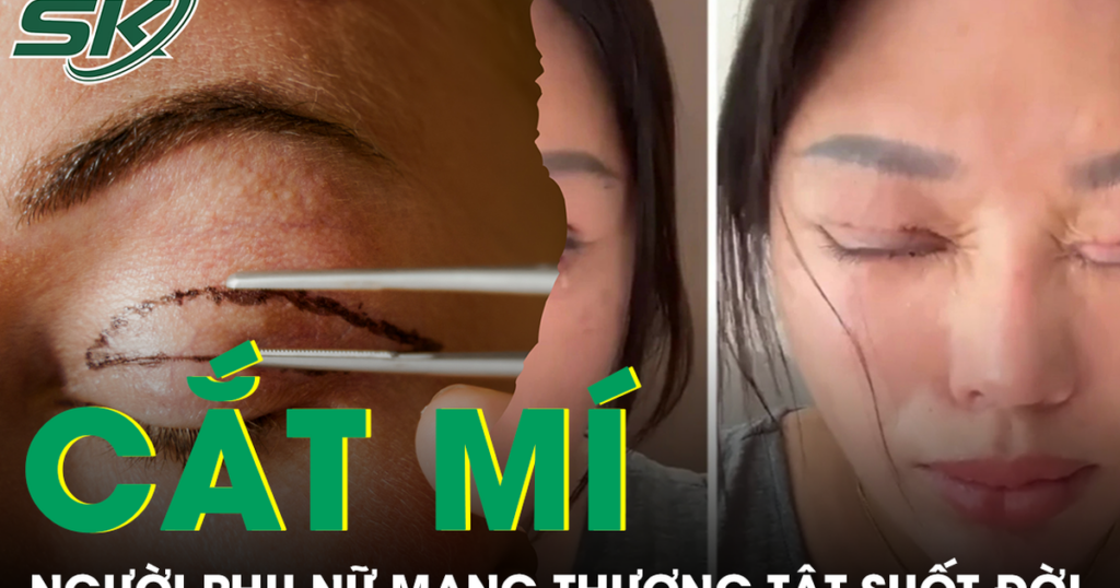 Tin lời ‘chuyên gia’ thẩm mỹ, người phụ nữ nhận kết cục đau đớn sau cắt mí mắt