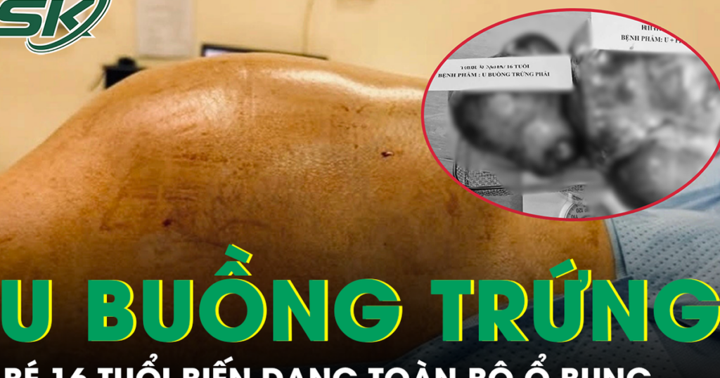 Bé gái 16 tuổi mang hai khối u buồng trứng khổng lồ gần 15kg, biến dạng toàn bộ ổ bụng