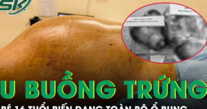 Bé gái 16 tuổi mang hai khối u buồng trứng khổng lồ gần 15kg, biến dạng toàn bộ ổ bụng