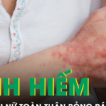 Căn bệnh hiếm khiến người phụ nữ sốt cao, toàn thân đỏ rực và bỏng rát dữ dội