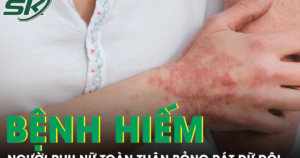 Căn bệnh hiếm khiến người phụ nữ sốt cao, toàn thân đỏ rực và bỏng rát dữ dội