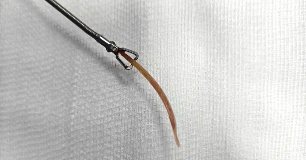 Người đàn ông bị tăm tre đâm thủng đại tràng