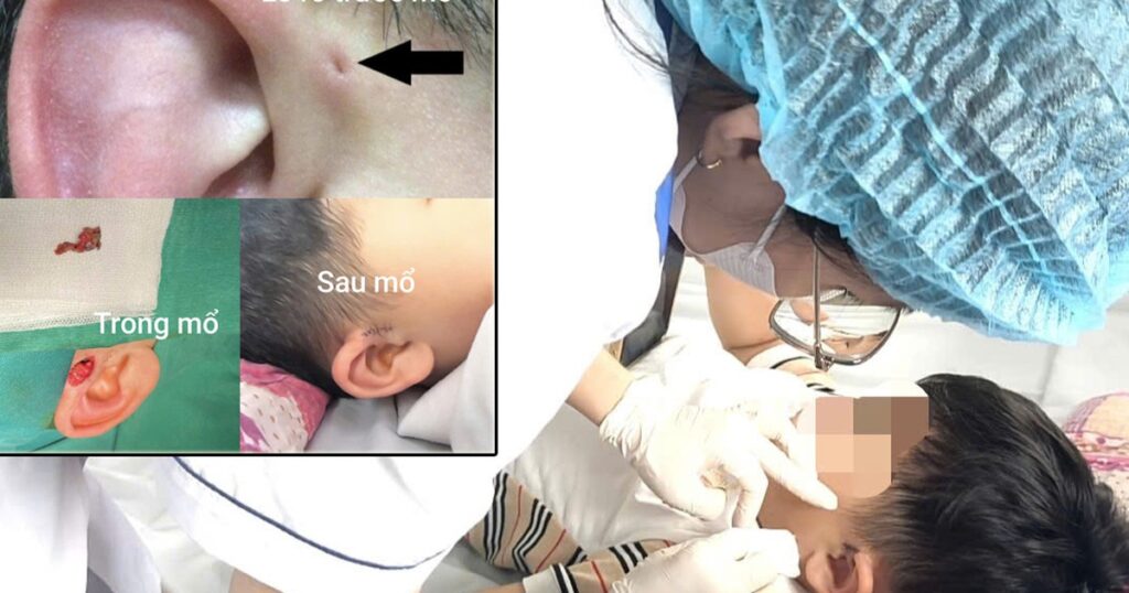 Hi hữu ca rò luân nhĩ di truyền qua 3 thế hệ
