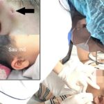 Hi hữu ca rò luân nhĩ di truyền qua 3 thế hệ
