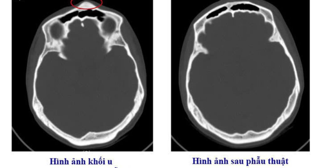 Bệnh viện Việt Nam – Thụy Điển Uông Bí phẫu thuật thành công ca u xương sọ hiếm gặp