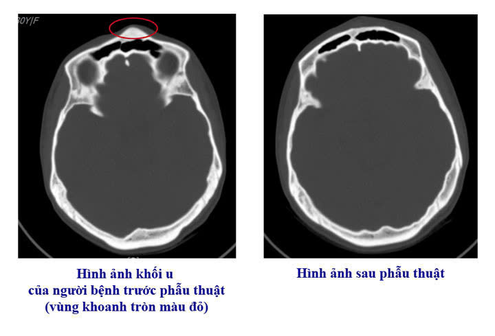 Bệnh viện Việt Nam - Thụy Điển Uông Bí phẫu thuật thành công ca u xương sọ hiếm gặp- Ảnh 1.