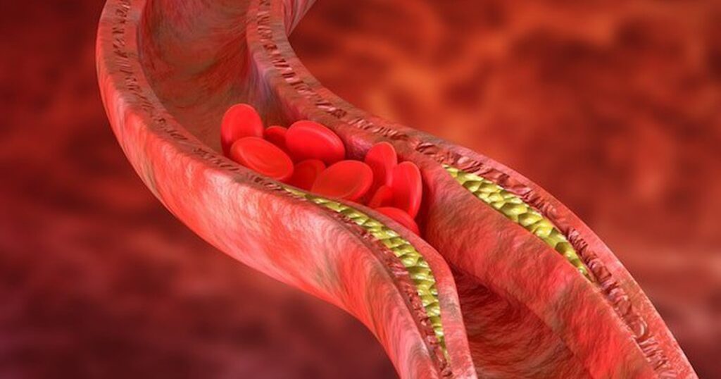Thay đổi lối sống giúp kiểm soát cholesterol cao, giảm nguy cơ bệnh tim mạch