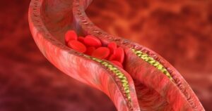 Thay đổi lối sống giúp kiểm soát cholesterol cao, giảm nguy cơ bệnh tim mạch
