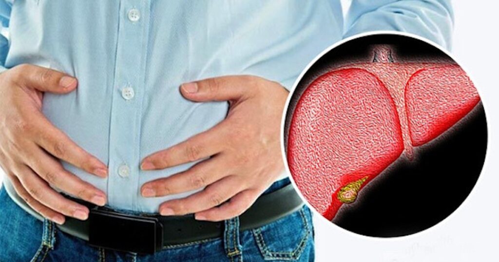 Nguyên nhân thường gặp khiến gan nhiễm mỡ ngày càng “trẻ hóa”
