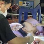 Vụ ông Nguyễn Tiến Nam: Bác sĩ nói gì về việc tự ý mổ u bằng dao điện cao tần?
