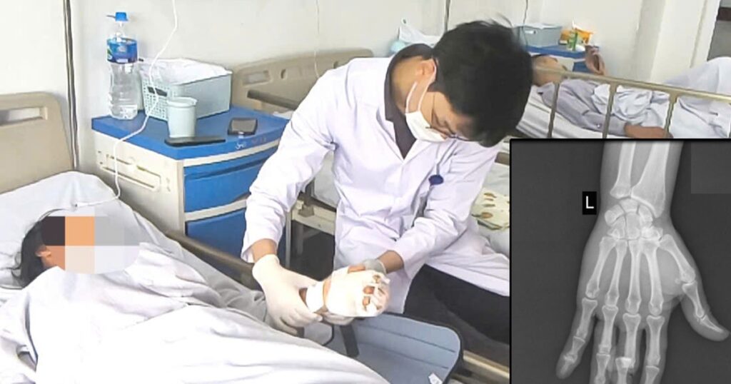 Vi phẫu cứu ngón tay đứt lìa cho nữ công nhân phụ hồ bị máy trộn bê tông cuốn nát bàn tay