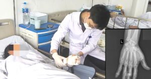 Vi phẫu cứu ngón tay đứt lìa cho nữ công nhân phụ hồ bị máy trộn bê tông cuốn nát bàn tay
