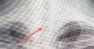 Sau ăn cá người đàn ông 46 tuổi bị mắc lưỡi câu sâu trong thực quản